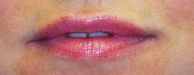 After Botox Treatment
