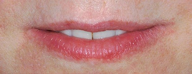 Before Botox Treatment