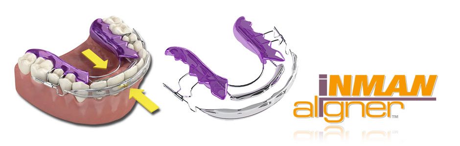 Inman Aligners Inman Aligners