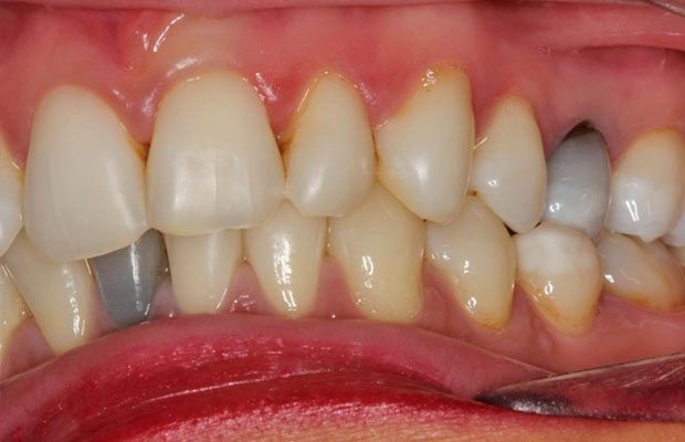 Before Internal Whitening Before Internal Whitening