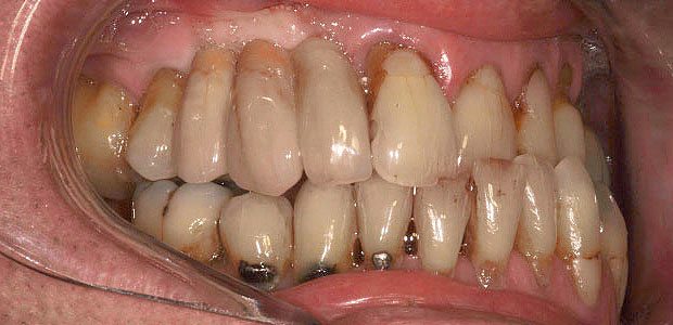 Teeth After Teeth After
