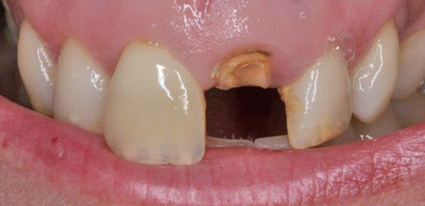 Teeth Before Teeth Before