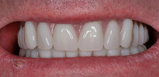 Teeth After
