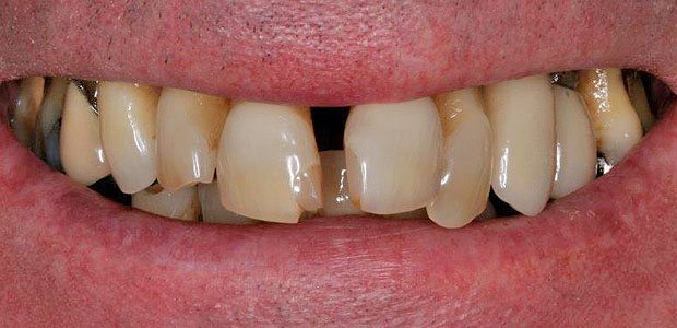 Teeth Before
