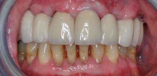 Teeth After Teeth After