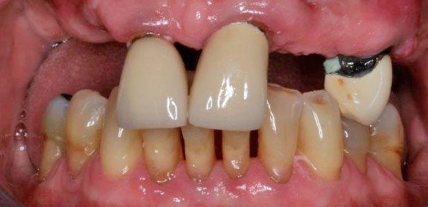 Teeth Before Teeth Before