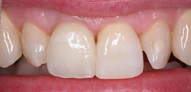 Teeth After Teeth After