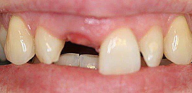 Teeth Before Teeth Before