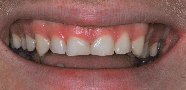 Teeth After Teeth After