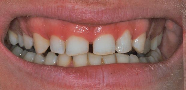 Teeth Before Teeth Before