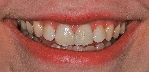 Teeth After Teeth After