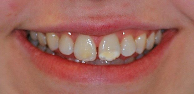 Teeth Before Teeth Before