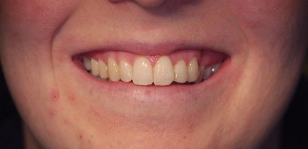 Teeth After Teeth After