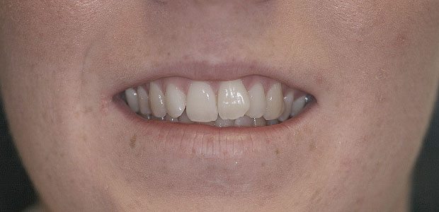 Teeth Before Teeth Before