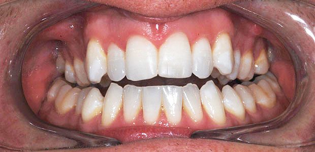 Teeth After Teeth After
