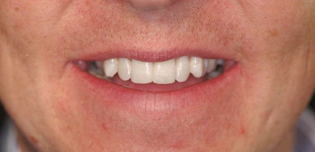 Teeth After Teeth After
