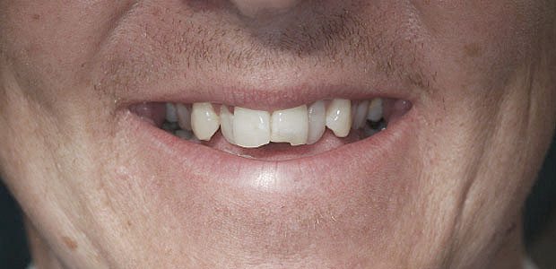 Teeth Before Teeth Before