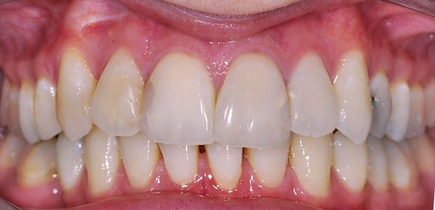Teeth After