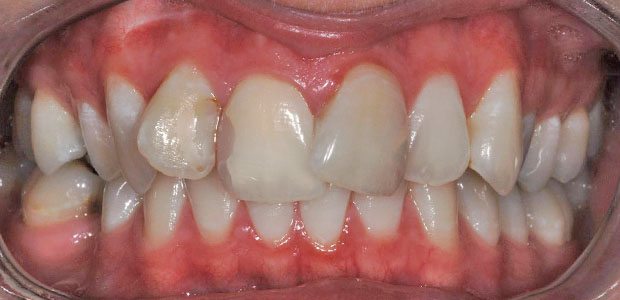 Teeth Before