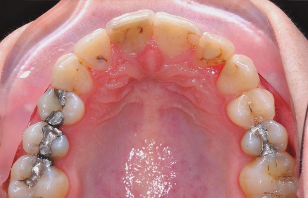 Teeth After Teeth After