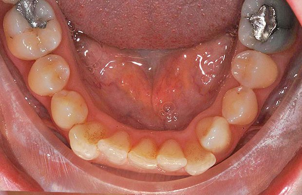 Teeth Before Teeth Before