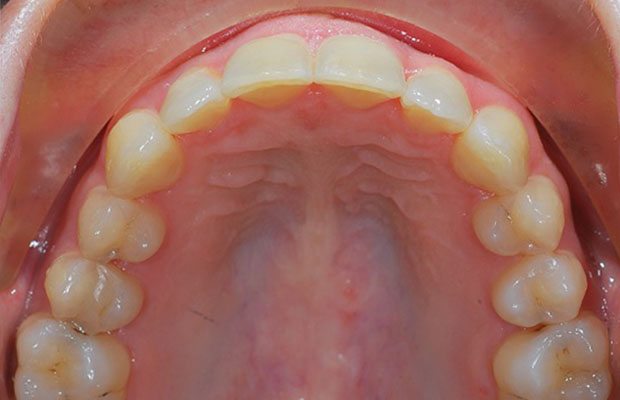 Teeth After Teeth After
