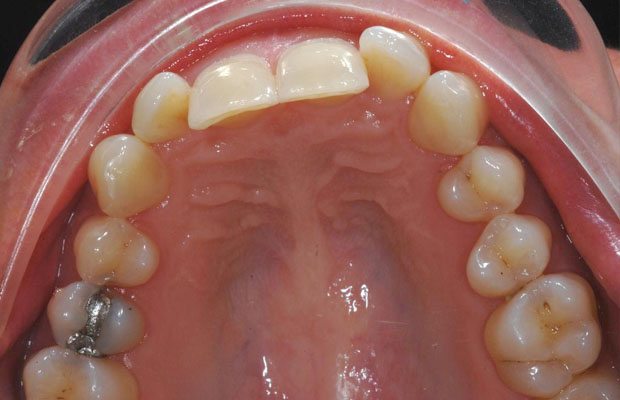 Teeth Before Teeth Before
