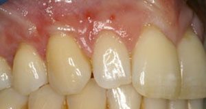 Teeth After