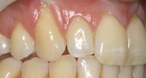 Teeth Before