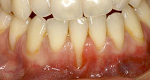 Teeth Before