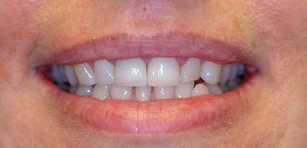 Teeth After Teeth After