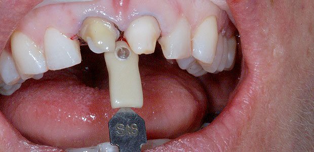 Teeth Before Teeth Before