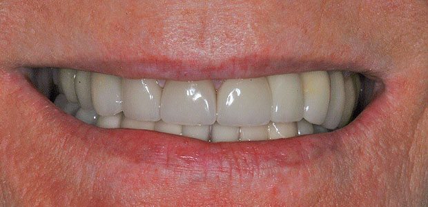Teeth After Teeth After