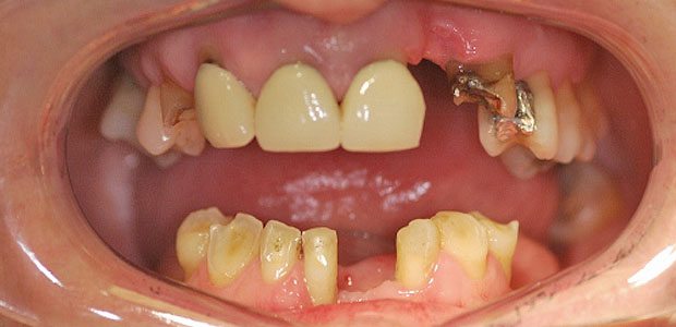 Teeth Before Teeth Before