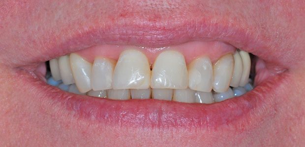 Teeth After Teeth After