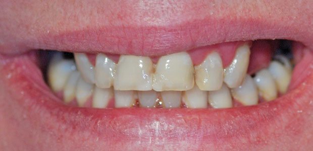 Teeth Before Teeth Before
