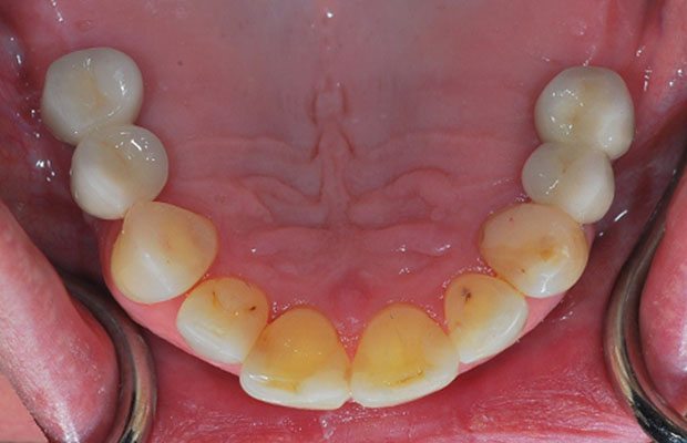 Teeth After Teeth After