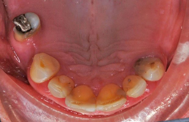 Teeth Before Teeth Before