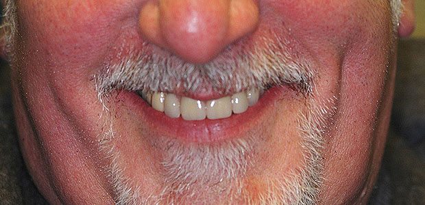 Teeth After Teeth After