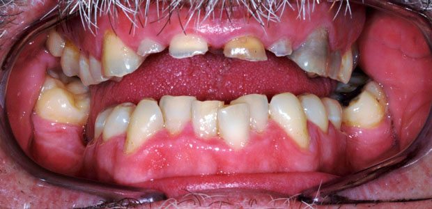 Teeth Before Teeth Before