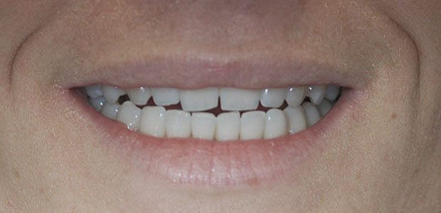 Teeth Before Teeth Before