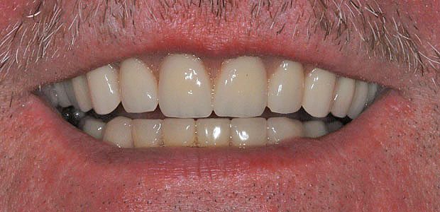 Teeth After Teeth After