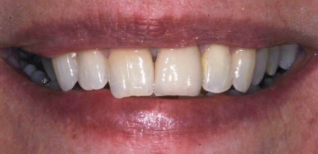 Teeth After Teeth After