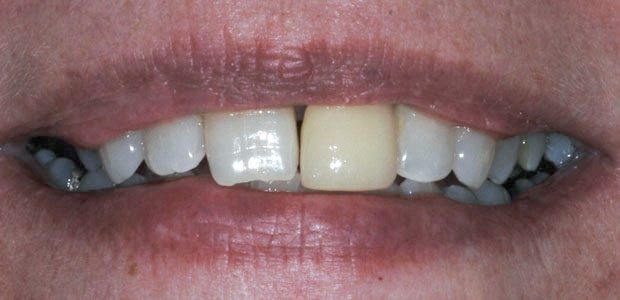 Teeth Before Teeth Before