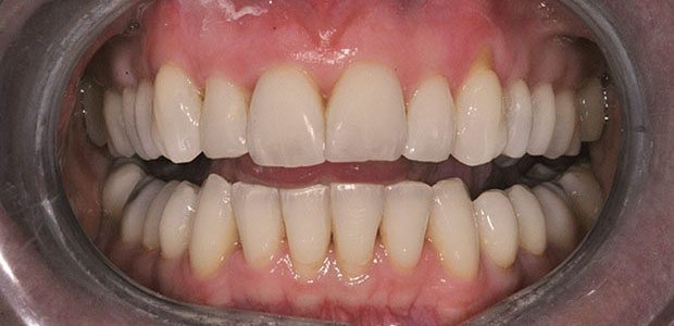 Teeth After Teeth After