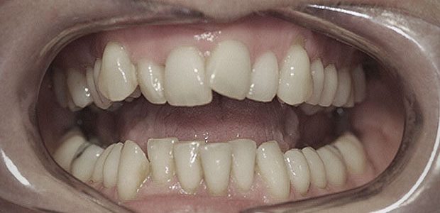 Teeth Before Teeth Before