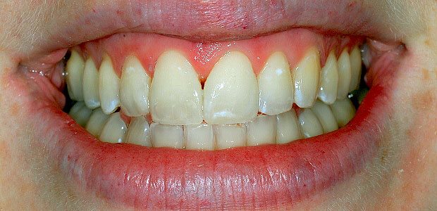 Teeth After Teeth After