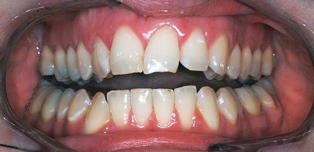 Teeth Before Teeth Before