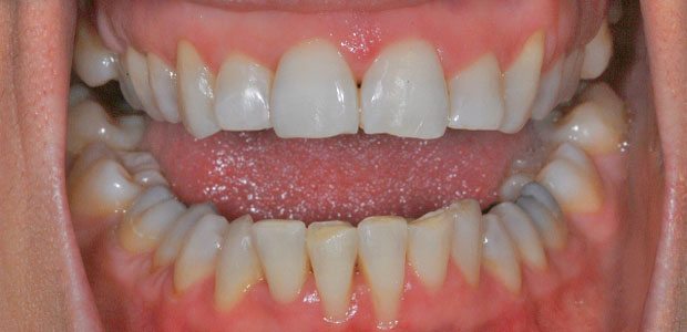 Teeth After Teeth After