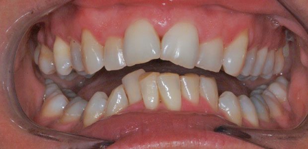 Teeth Before Teeth Before